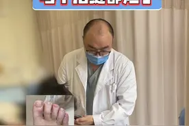 脚气导致足部溃烂不愈合，每个趾缝都烂了！ 糖友足部的健康很重要，一些细微的小问题都可能引发严重后果，#糖尿病足 及时就医，找对医生，避免情况严重。#糖尿病足早期表现视频封面