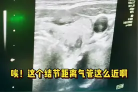 甲状腺乳头状癌消融手术实录 #甲状腺结节 #射频消融 #手术视频封面