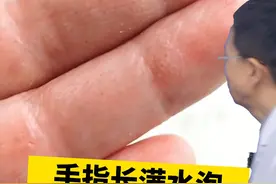 手指、指缝长透明小水泡，奇痒无比，这个视频教你处理 #汗疱疹 #科普 #糠酸莫米松凝胶