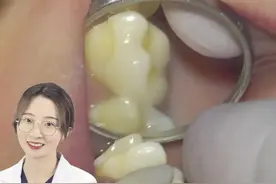 蛀牙后除了树脂修复外，有些情况下还可以选择嵌体修复哦！#牙医日常 #爱护牙齿 #美牙修复 #蛀牙补牙视频封面