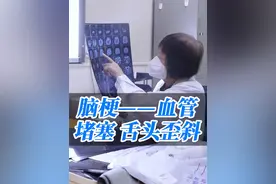 脑梗的症状有哪些？舌头歪斜、一侧手脚无力等，都是脑梗的症状。#医学科普 #门诊日常 #脑梗 #舌头歪斜 #医者仁心视频封面