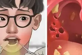 #热点 #热点话题 #热点助手 第一视觉体验医生清理扁桃体结石视频封面