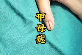 指甲长出一条黑色的，甲母痣建议切除 #甲母痣和甲黑线的区别 #甲母痣一定要切掉吗 #甲母痣怎么消除 #甲母痣 #甲母痣切除视频封面
