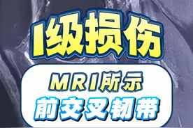 MRI所示前交叉韧带I级损伤 #医学影像 #医学生视频封面