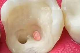 牙齿疼痛的厉害才去看牙医？其实在我们牙齿已经出现黑点或者黑线的时候大家就要提高警惕了！#口腔科普 #知识科普 #根管治疗 #牙齿龋坏视频封面