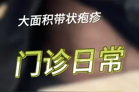 门诊日常——腰腹部大面积带状疱疹 #带状疱疹 #带状疱疹后神经痛 #抖出健康知识宝藏 #抖音知识年终大赏 #疼痛科郑拥军视频封面