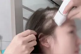 头皮反复长头屑，还特别痒，这可能是脂溢性皮炎，剃光头也没用！ 医生教你正确处理#头痒 #头油 #头屑 #脂溢性皮炎 #抖出健康知识宝藏视频封面