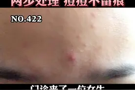 频繁长痘痘要重视，特别是青春期的孩子，越早处理越好#甲硝唑凝胶#壬二酸#父母##皮肤#痘痘#青春期 视频封面