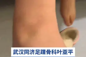 两个月前崴脚到现在，脚肿的特别厉害 #崴脚 #脚肿了 #硬核健康科普行动视频封面