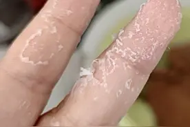 这个富贵病不是矫情，手指脱皮、有裂口，不是干燥，这是#角化型湿疹  #医学科普 #皮肤 #湿疹 #手脱皮视频封面