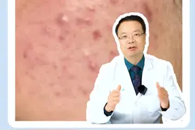 皮肤科医生教你应对，既敏感又长痘怎么治？#皮肤科医生谢红付 #痤疮 #敏感视频封面