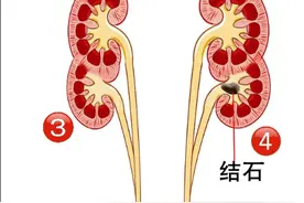 #医学科普 正常人有两个肾，婆婆居然长了四个肾？？！！#肾结石视频封面