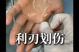 擦洗油烟机，一不小心就把手指肌腱割断了！ #手术室日常  #手术  #骨科蒋江云医生  #肌腱断裂 #医学科普视频封面