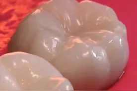 牙齿被细菌侵蚀后是如何修复的？一起来看看拯救龋齿的全过程吧！ 有蛀牙一定要及时处理哦
#蛀牙 #补牙 #补牙过程 #口腔科普 #口腔健康视频封面