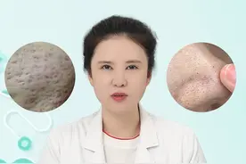 痘坑，毛孔粗大怎么办？有哪些方法？ #毛孔粗大 #痘坑 #点阵激光 #光子嫩肤 #微针 @抖音短视频视频封面
