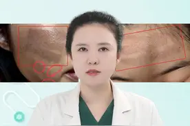 光子嫩肤灼伤，反黑怎么办？ #光子嫩肤 #光子 #反黑 #黄褐斑 #硬核健康科普行动视频封面