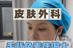手掌色素痣偏大，选择分次切除的优势是什么 #痣 #色素痣 #切痣 #医学科普视频封面