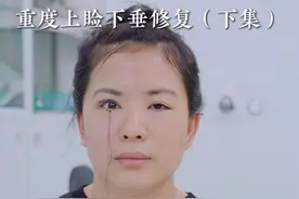 来自江苏常州的姑娘，重度上睑下垂修复（下）#眼整形医生杨锋 #上睑下垂 #上睑下垂杨锋视频封面