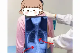 16岁小姑娘  侧弯度数较大！ #青少年脊柱侧弯 #脊柱侧弯孙新志 #硬核健康科普行动 #脊柱侧弯保守 #郑大一附院骨科孙新志视频封面