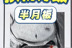 半月板损伤分级 #医学影像 #医学生 #医疗创作者培优计划 #半月板视频封面
