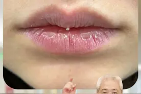 嘴唇总是干燥起皮，它可不是单纯的喝水喝少了！ 当心是#唇炎#剥脱性唇炎  #医学科普 #硬核健康科普行动  #嘴唇干裂视频封面