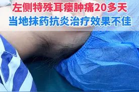 特殊型耳前瘘管，瘘管在外耳道，肿胀非常厉害，要么切排要么直接手术#耳前瘘管 #抖出健康知识宝藏  #武汉陈金辉 #医生AI分身视频封面