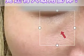 泪沟填完玻尿酸都鼓包了，竟还有人推荐用膨体？玻尿酸真的就比膨体安全？#泪沟 #膨体泪沟 #抖出健康知识宝藏 #2024抖音生活记忆 #泪沟凹陷视频封面