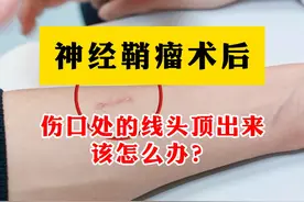 神经鞘瘤术后伤口处的线头顶出来该怎么办？ #周围神经外科医生廉民学  #神经鞘瘤  #神经鞘瘤手术  #硬核健康科普行动   #年度健康知识干货大赏视频封面