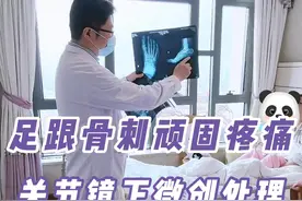 对于疼痛反复发作、顽固的骨刺，关节镜下微创根治也是一种比较好的办法#骨刺 #关节镜 #开工健康手册 #关节 #骨刺脚痛视频封面