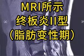MRI所示终板炎II型：脂肪变性期 #医学影像 #医学生 #腰椎视频封面