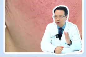 玫瑰痤疮不敢运动，稍微动一下就发红发烫，怎么办？#皮肤科医生谢红付 #玫瑰痤疮 #抖出健康知识宝藏视频封面