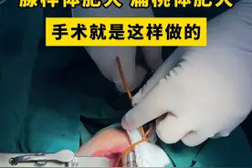 #腺样体肥大手术 #耳鼻喉臧洪瑞视频封面