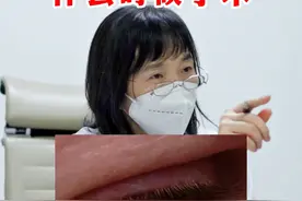 麦粒肿什么时候应该手术？#麦粒肿 #针眼麦粒肿 #健康科普 @抖音热点 @抖音短视频视频封面