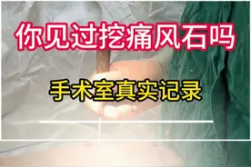 痛风石也能“挖呀挖呀”吗？ #痛风石 #挖呀挖呀挖 #真实记录  #医学科普视频封面