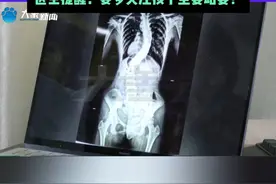 13岁女孩脊柱侧弯达60度，医生提醒：要多关注孩子坐姿站姿！#媒体精选计划视频封面