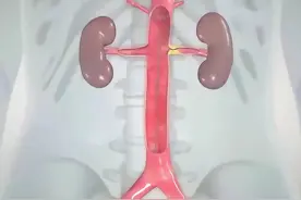 肾动脉狭窄扩张 #肾动脉狭窄 #球囊扩张术 #硬核健康科普行动  #介入手术视频封面