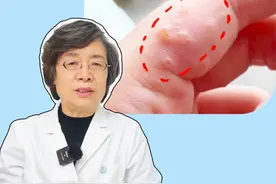 手上有这个病的女生要少做家务！#医学科普 #汗疱疹 #皮肤 #止痒 #糠酸莫米松凝胶视频封面