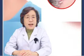 头皮出现很多头皮屑，还有红斑，轻轻一刮能看到点状出血，这是银屑病！#医学科普 #抖出健康知识宝藏  #银屑病 #头屑 #科普视频封面