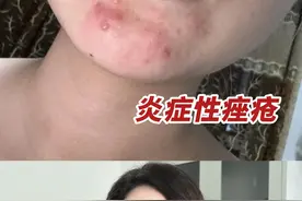这支药膏能够治疗身上的多种疙疙瘩瘩，省钱又省事!#痘痘  #前胸后背痘  #火疖子  #毛囊炎  #医学科普视频封面