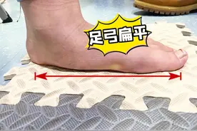 扁平足不干预对孩子有哪些影响！ #扁平足 #扁平足矫正 #扁平足的孩子 #医学科普 #儿童骨科视频封面