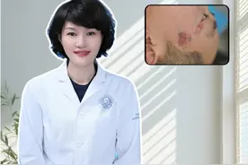 肥厚型鲜红斑痣，看看钟教授如何用激光操作 #抖出健康知识宝藏  #健康无畏自在如她  #她们的精选  #长春 #激光