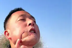 #吃槟榔15年换上口腔癌的男子现身说法 ，“没碰过的不要碰，正在吃的早日戒”视频封面