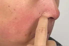 这可不是皮肤干燥，当心是脂溢性皮炎！不想反复尽早处理#干燥#起皮#脂溢性皮炎#护肤#抖出健康知识宝藏视频封面