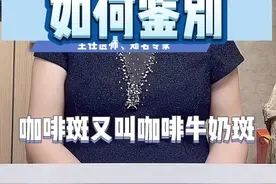 儿童咖啡斑与神经纤维瘤病如何鉴别#咖啡斑 #神经纤维瘤 #北京儿童医院 #邢嬛 #医学科普