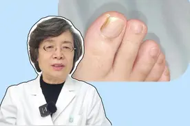 指甲变空、增厚、一剪就碎，都是灰指甲的典型表现，这个病越拖越严重，一定要及时处理！#灰指甲 #传染 #医学科普 #灰指甲初期的照片 #灰指甲专用药视频封面