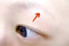 眉毛少的人咋办？米诺地尔可以涂眉毛吗？  #健康科普 #眉毛稀疏#知识分享 视频封面