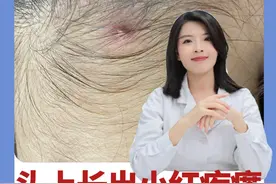 头上长痘痘，一碰就痛！千万别抠，小心头上秃一块#医学科普 #毛囊炎 #健康科普 #头皮毛囊炎视频封面