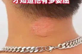 爱生气、受委屈的人，脖子后面容易长这种苔藓红斑#医学科普 #神经性皮炎 #皮肤 #皮炎视频封面