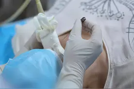 30秒带你了解甲状腺结节穿刺全过程，是不是没有想象中可怕#甲状腺穿刺 #甲状腺 #科普一下视频封面