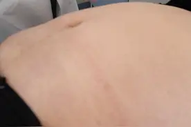 300多斤的大肚子像怀了三胞胎睡觉都不能平躺着睡#肥胖 #减重手术 #硬核健康科普行动  #健康视频封面